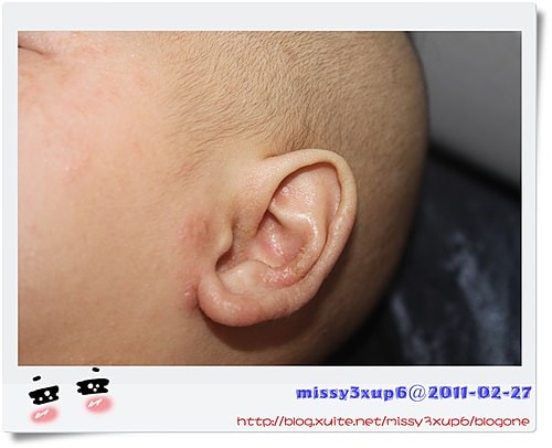 【愷愷】千媽送的KA及令人心疼的異位性皮膚炎