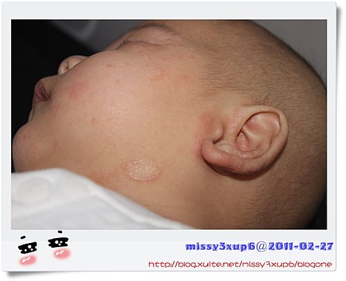 【愷愷】千媽送的KA及令人心疼的異位性皮膚炎