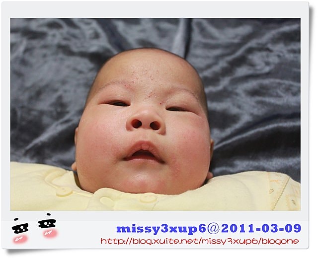 【愷愷】對付異位性皮膚炎，益生菌真有效