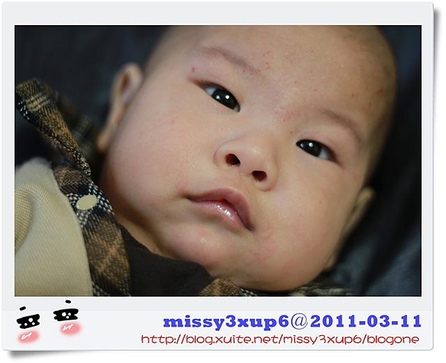 【愷愷】對付異位性皮膚炎，益生菌真有效