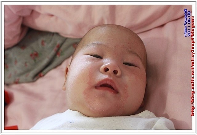 【愷愷】4m30d令人心疼，時好時壞的皮膚