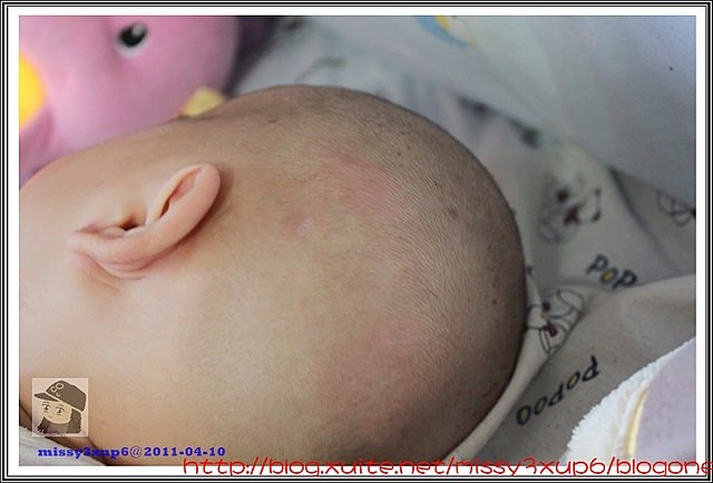 【愷愷】4m30d令人心疼，時好時壞的皮膚