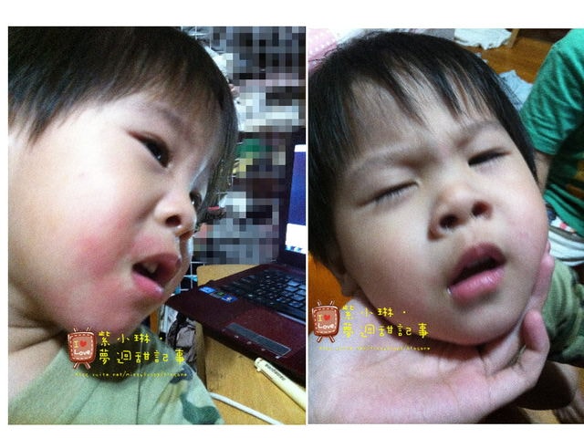 愷兒的嬰兒肌@紅紅通通不見了!!!!!